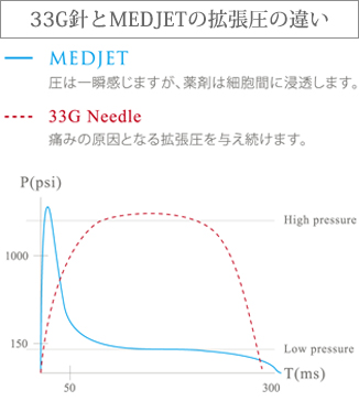 33G針とMEDJETの拡張圧の違い