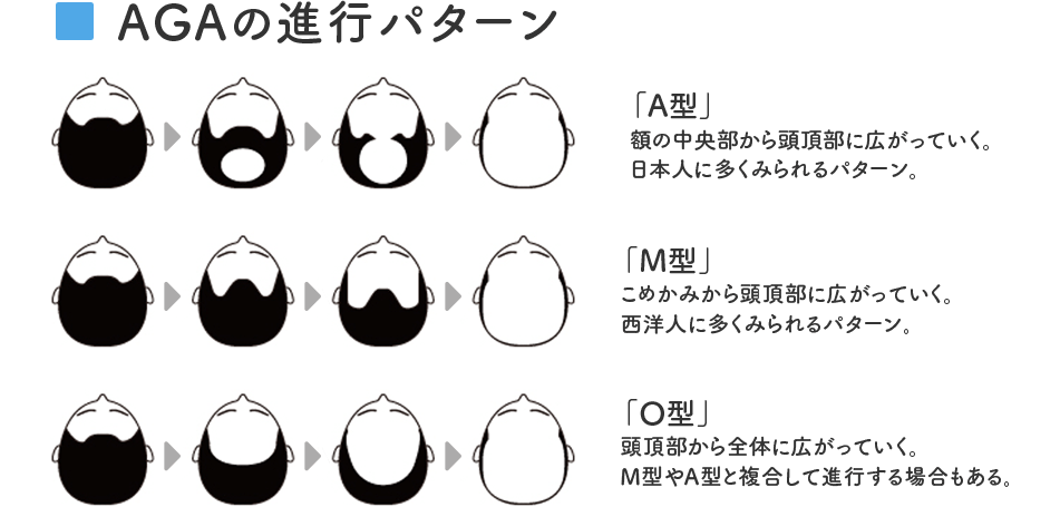 AGAのパターン