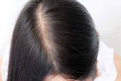 女性の薄毛治療 びまん性 脱毛症 札幌中央クリニック